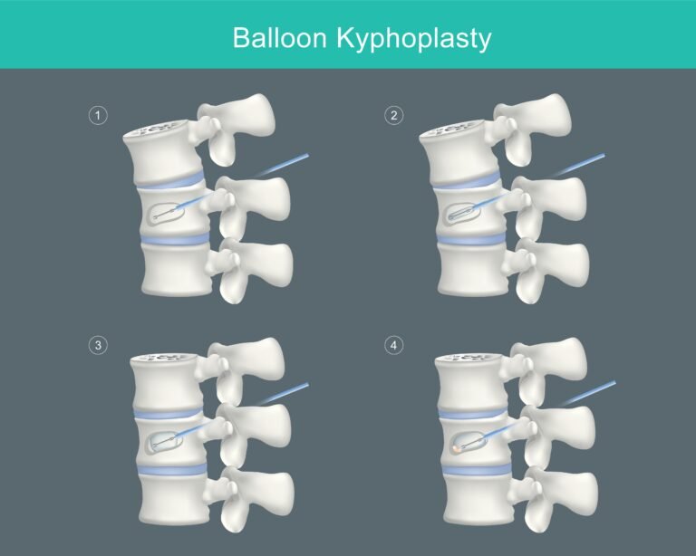 Kyphoplasty